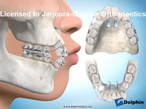 Multiattach et extraction de quatre prémolaires