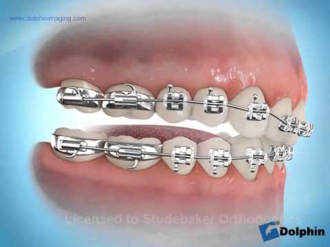 Multiattache et cales rétropincisives